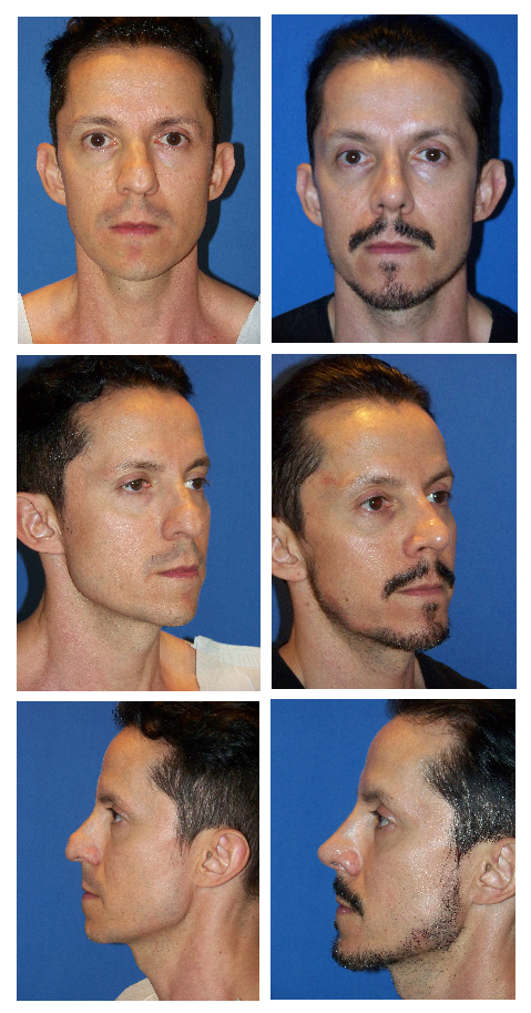 Before and After Image: Rhinoplasty - front