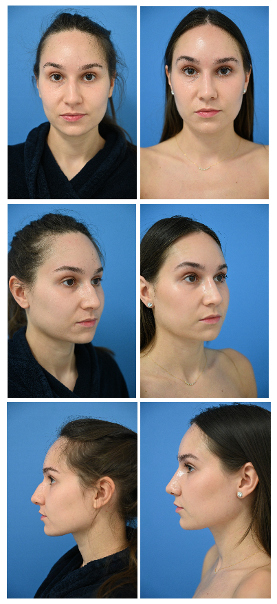 Before and After Image: Rhinoplasty - front