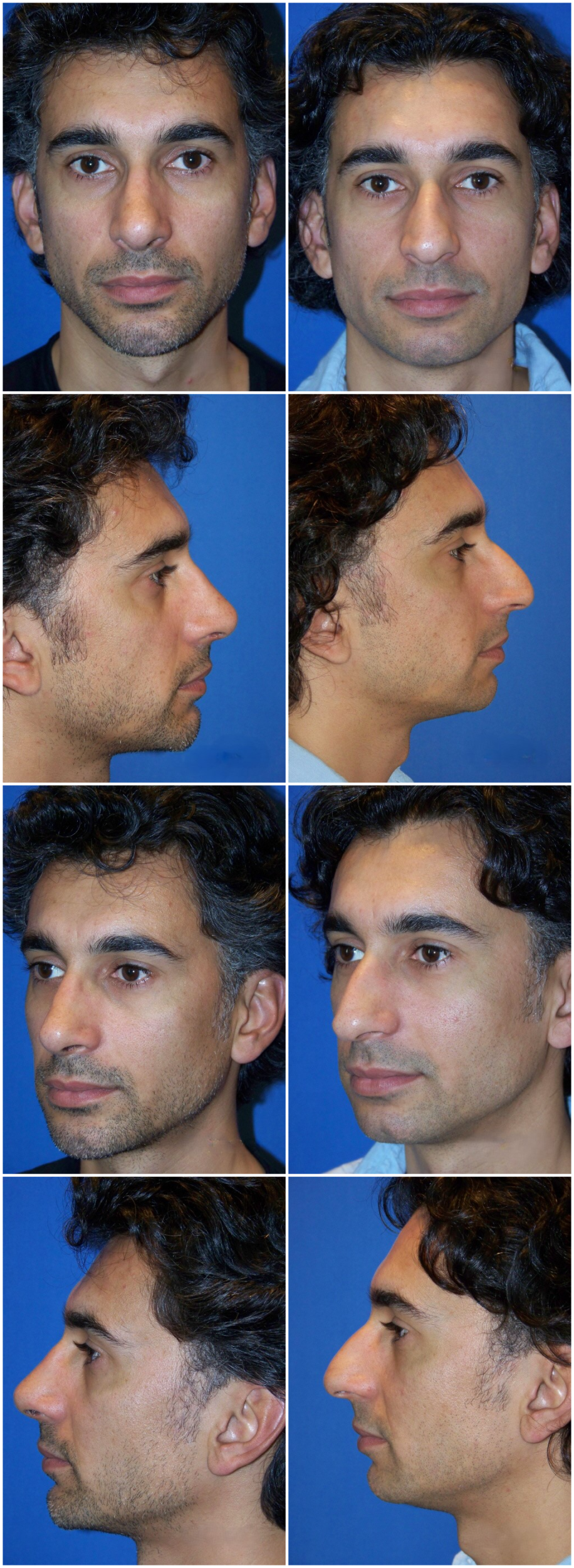 Before and After Image: Rhinoplasty - front